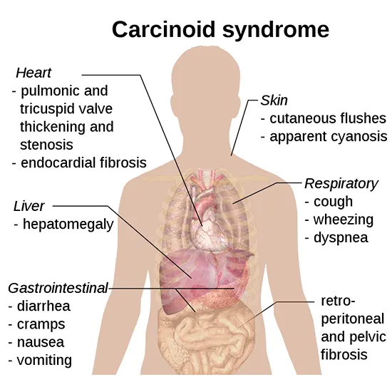 carcinoid syndrome package test